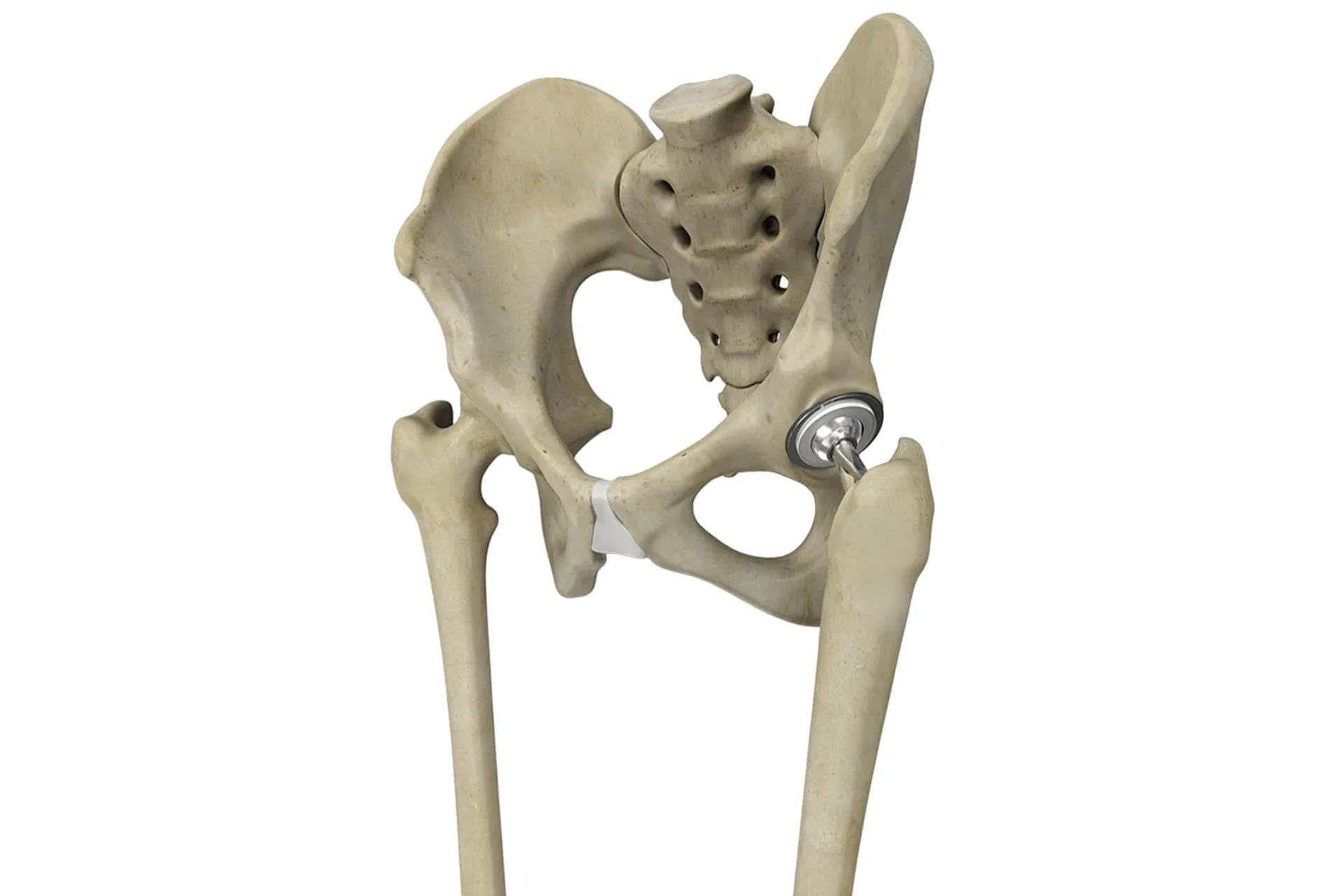 Artroplastia de cadera y rodilla